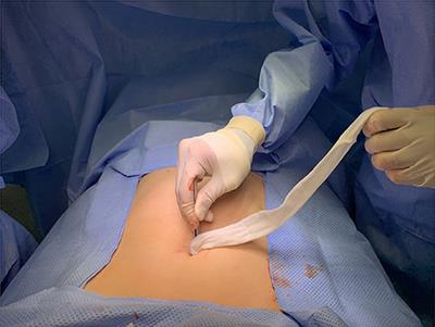 Wound Irrigation Using Wet Gauze May Reduce Surgical Site Infection Following Laparoscopic Appendectomy